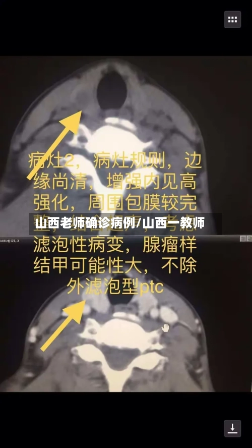 山西老师确诊病例/山西一教师-第3张图片
