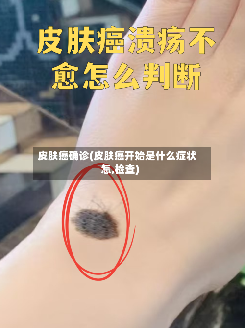 皮肤癌确诊(皮肤癌开始是什么症状怎,检查)