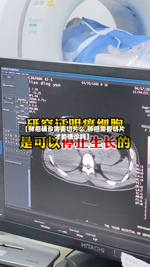 【肺癌确诊需要切片么,肺癌需要切片才能确诊吗】-第2张图片