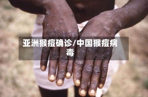 亚洲猴痘确诊/中国猴痘病毒-第2张图片