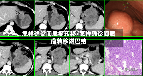 怎样确诊间质瘤转移/怎样确诊间质瘤转移淋巴结
