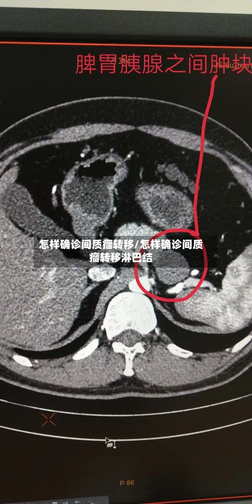 怎样确诊间质瘤转移/怎样确诊间质瘤转移淋巴结-第2张图片