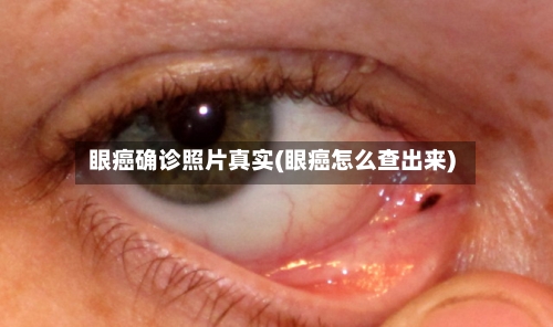 眼癌确诊照片真实(眼癌怎么查出来)-第2张图片
