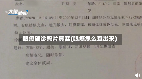 眼癌确诊照片真实(眼癌怎么查出来)