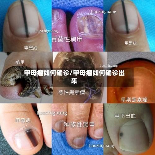 甲母瘤如何确诊/甲母瘤如何确诊出来