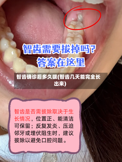 智齿确诊后多久拔(智齿几天能完全长出来)