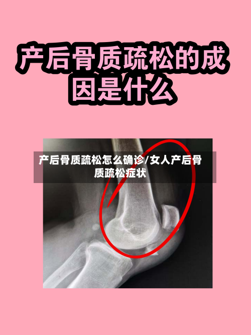 产后骨质疏松怎么确诊/女人产后骨质疏松症状