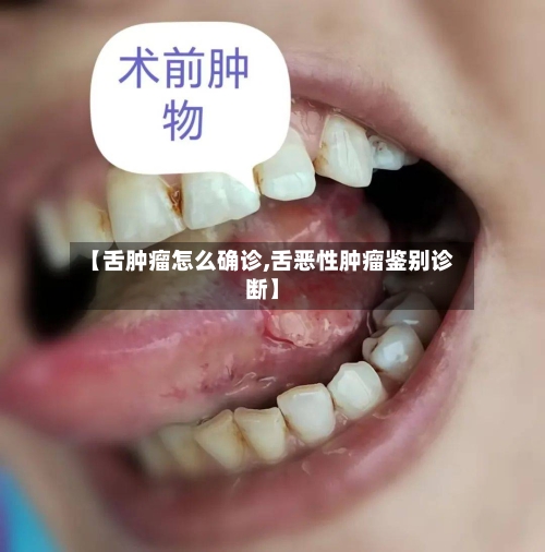 【舌肿瘤怎么确诊,舌恶性肿瘤鉴别诊断】