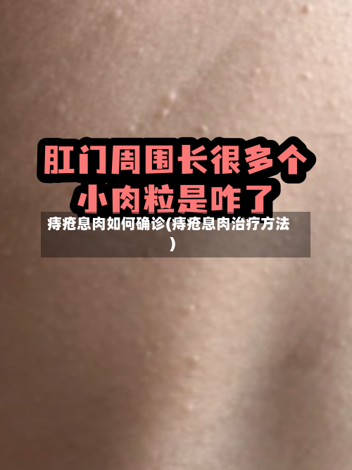 痔疮息肉如何确诊(痔疮息肉治疗方法)