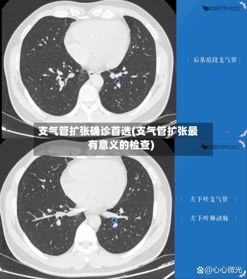 支气管扩张确诊首选(支气管扩张最有意义的检查)