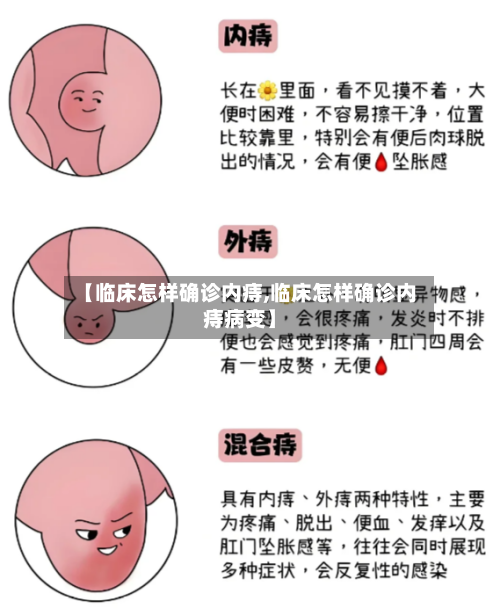【临床怎样确诊内痔,临床怎样确诊内痔病变】-第3张图片