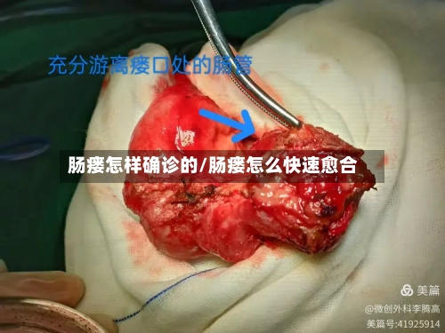 肠瘘怎样确诊的/肠瘘怎么快速愈合-第2张图片