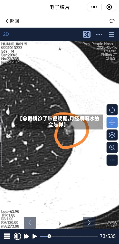【总裁确诊了肺癌晚期,月经期喝冰的会怎样】