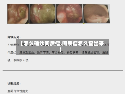 【怎么确诊间质瘤,间质瘤怎么查出来】